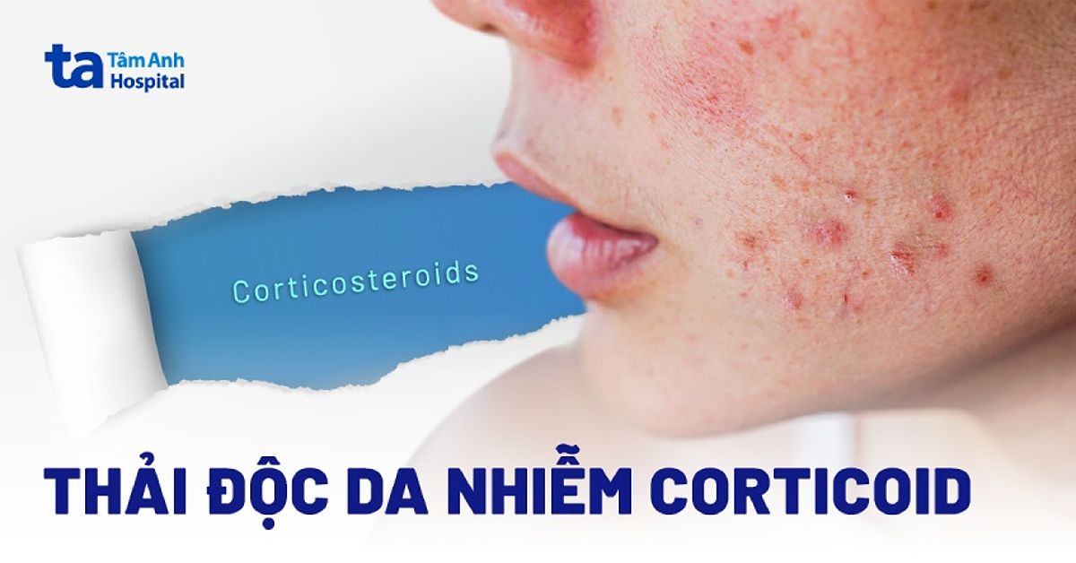 Cách thải độc da nhiễm Corticoid